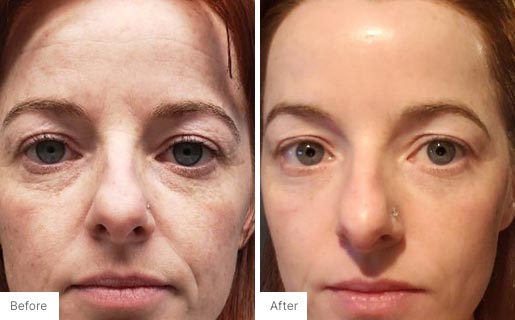 4 - Before and After Real Results of Age IQ Day Cream on a woman's face
