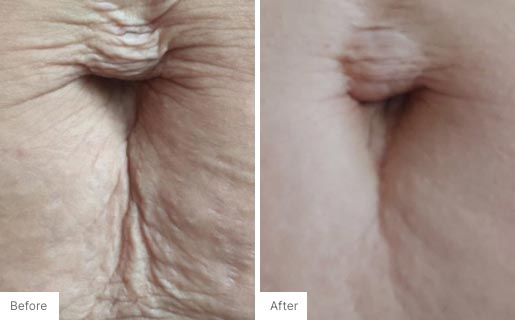 4 - Before and After Real Results photo of someone's belly button.